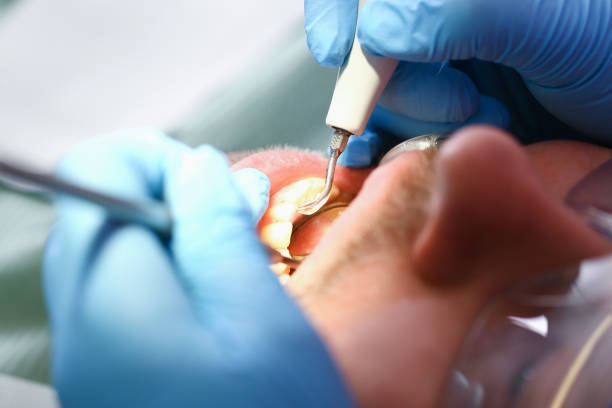 Best Emergency Wisdom Teeth Removal in Sturgeon, MO